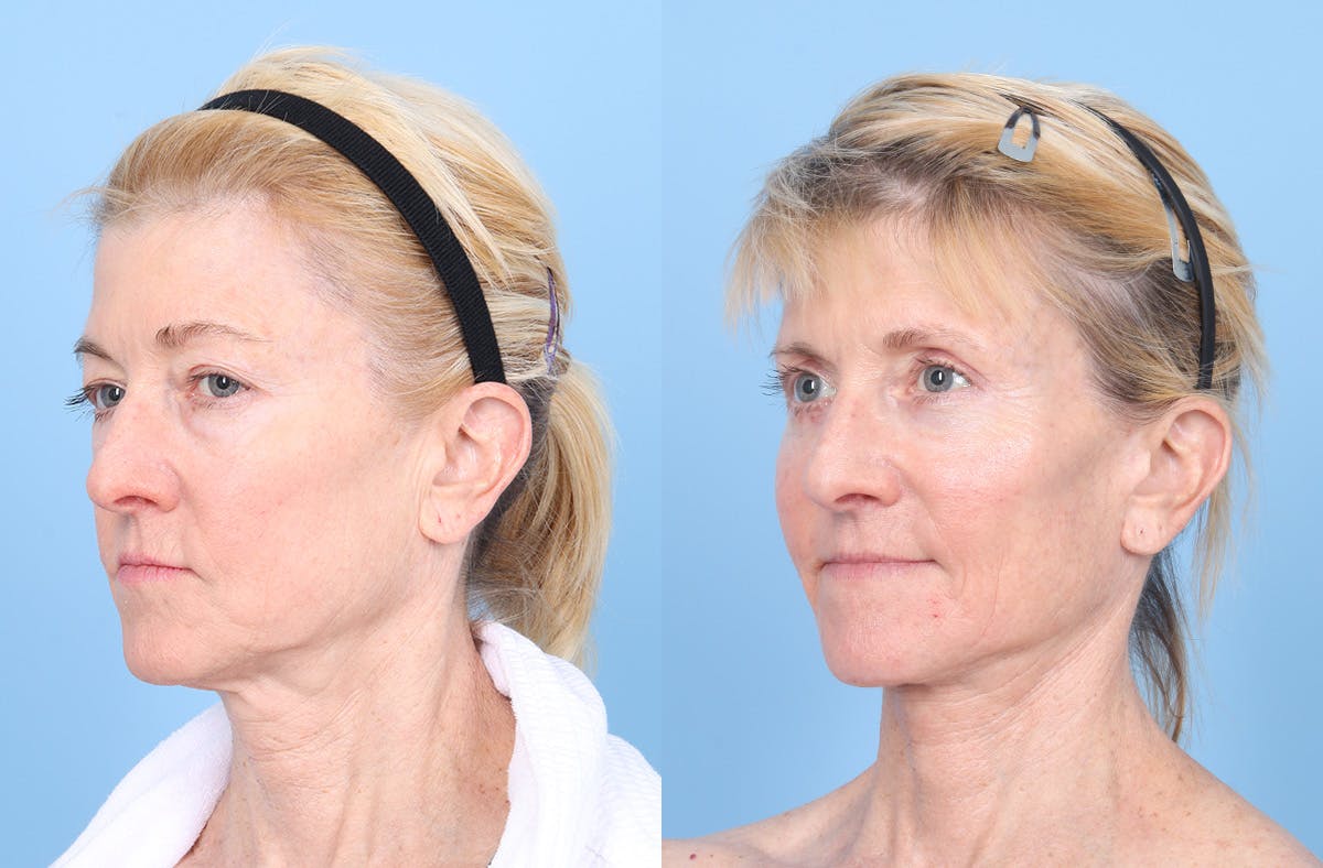 Neck Lift Before & After Gallery - Patient 842296 - Image 2