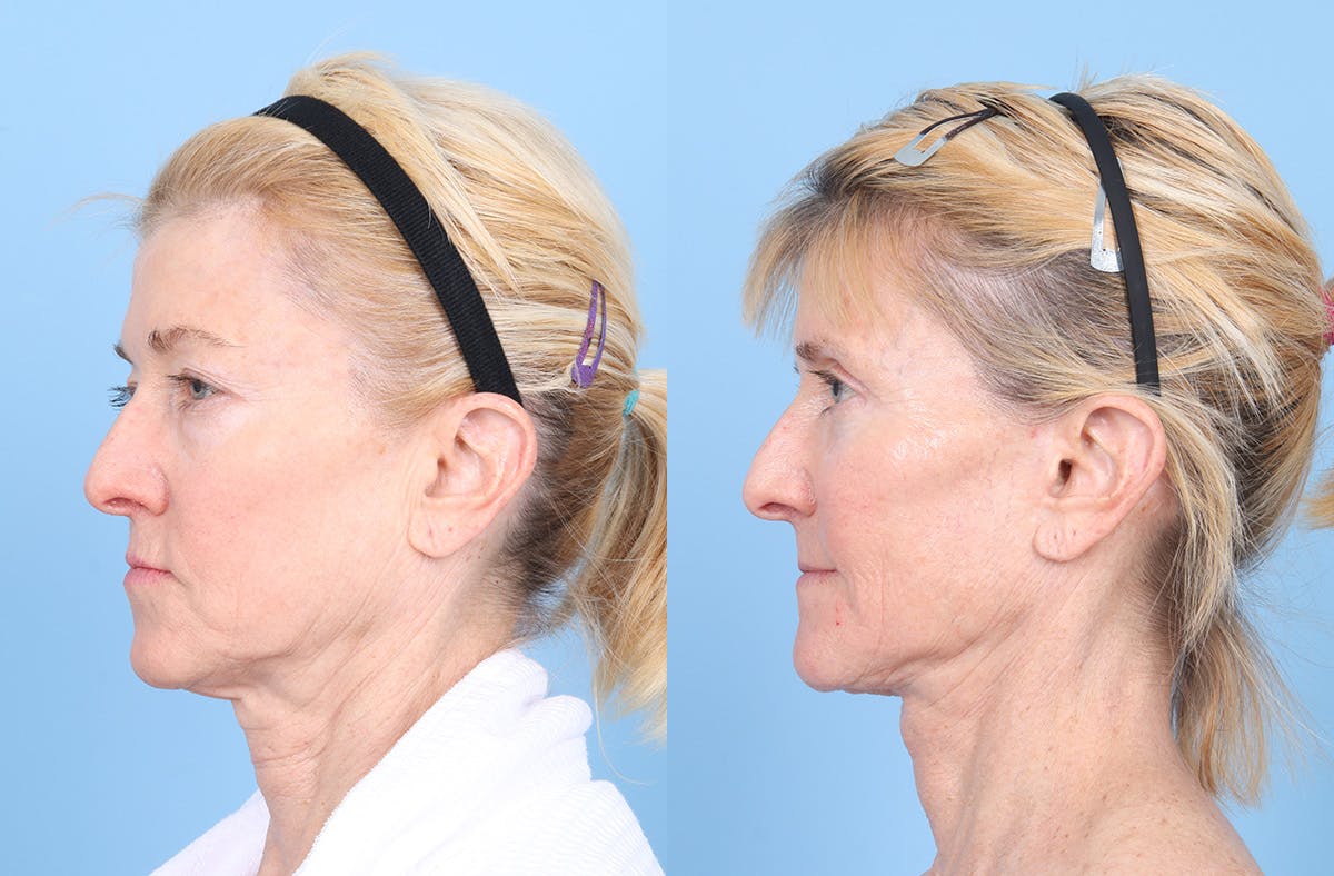 Neck Lift Before & After Gallery - Patient 842296 - Image 1