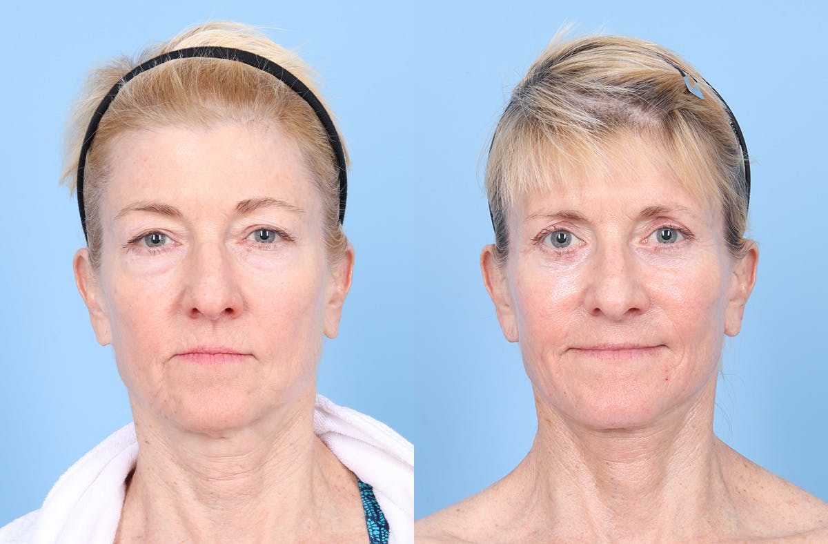 Neck Lift Before & After Gallery - Patient 842296 - Image 3