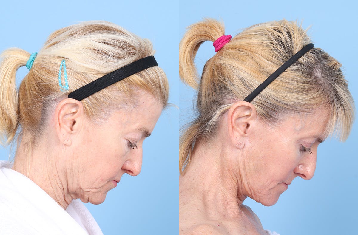 Neck Lift Before & After Gallery - Patient 842296 - Image 6