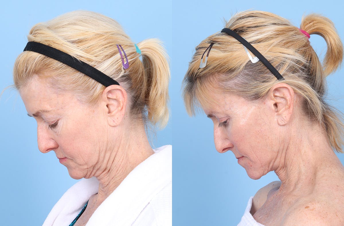 Neck Lift Before & After Gallery - Patient 842296 - Image 4