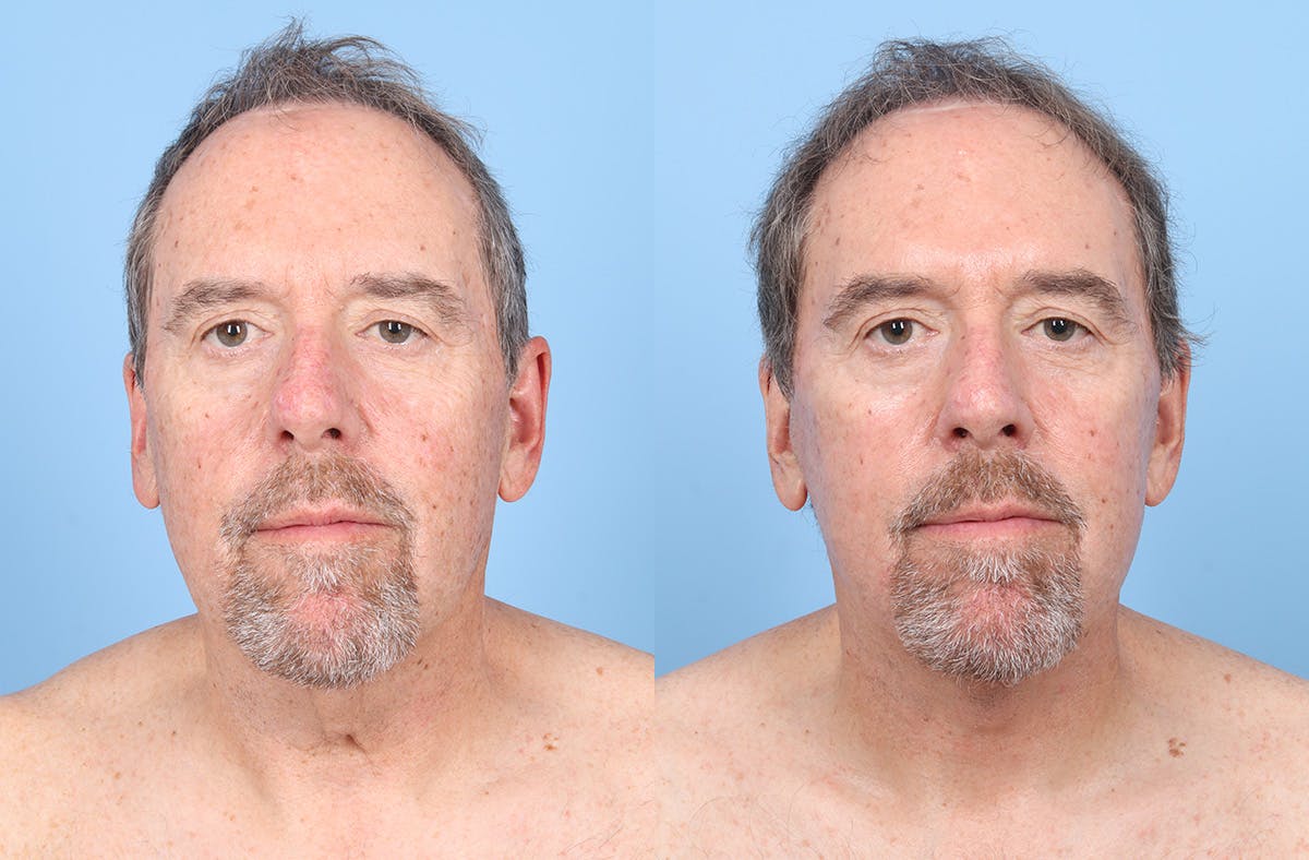 Neck Lift Before & After Gallery - Patient 274788 - Image 3