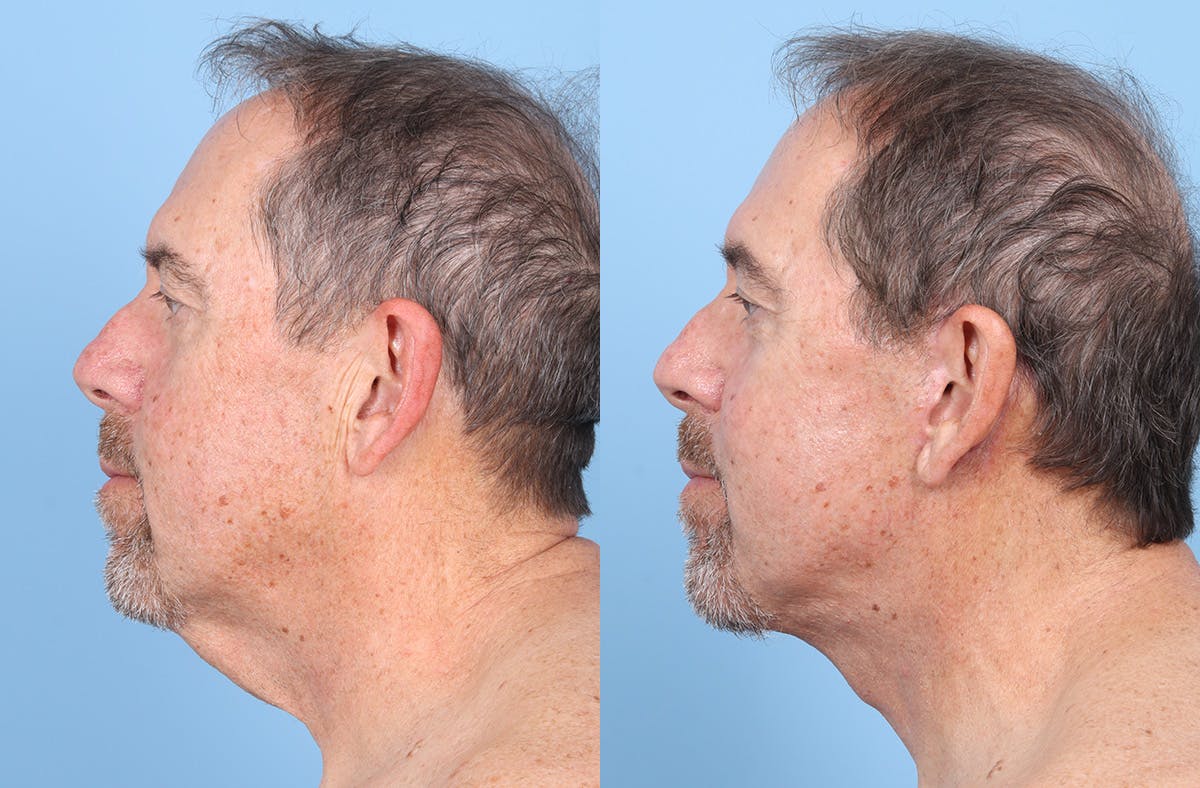 Neck Lift Before & After Gallery - Patient 274788 - Image 1