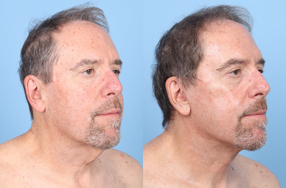 Neck Lift Before & After Gallery - Patient 274788 - Image 4