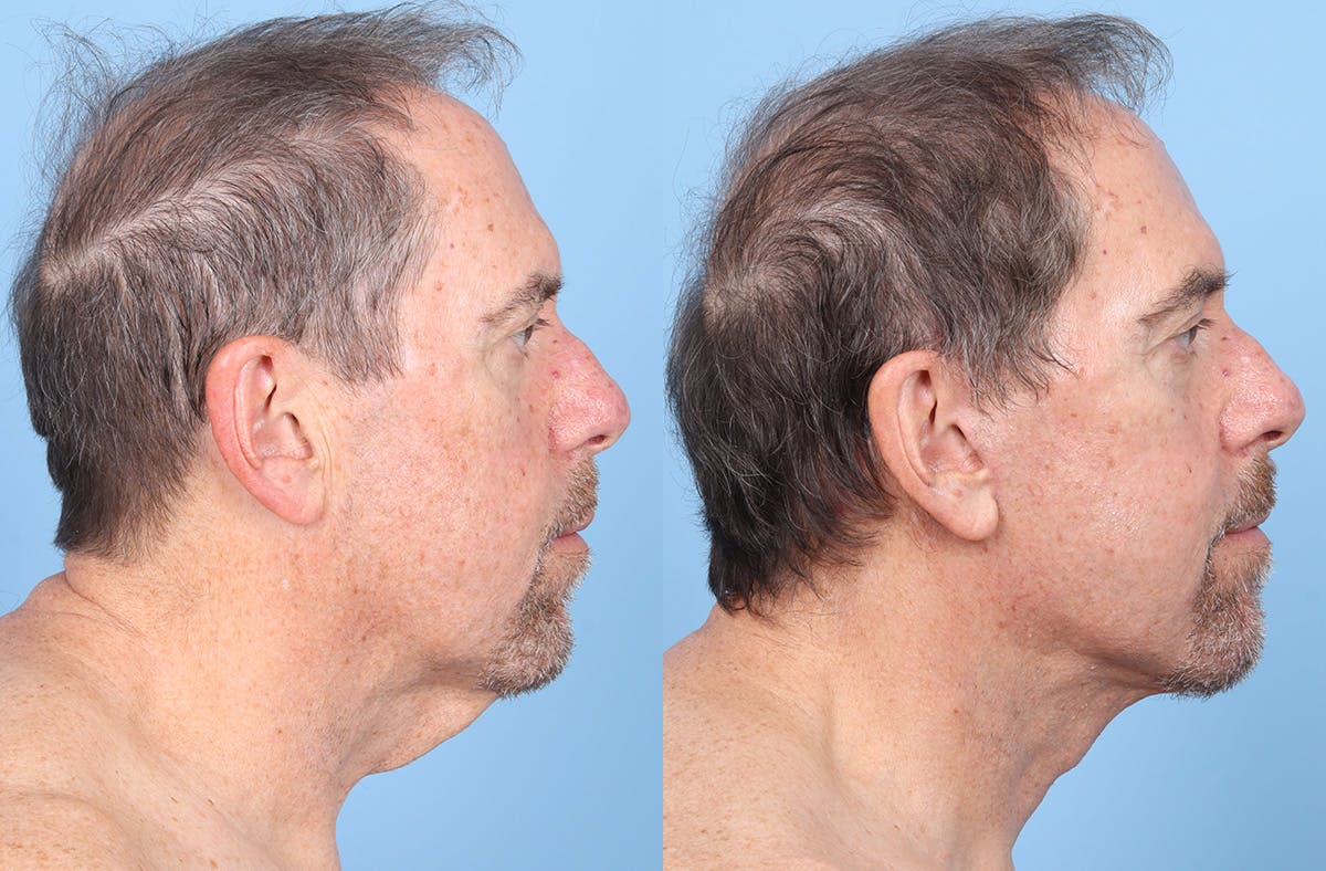 Neck Lift Before & After Gallery - Patient 274788 - Image 5