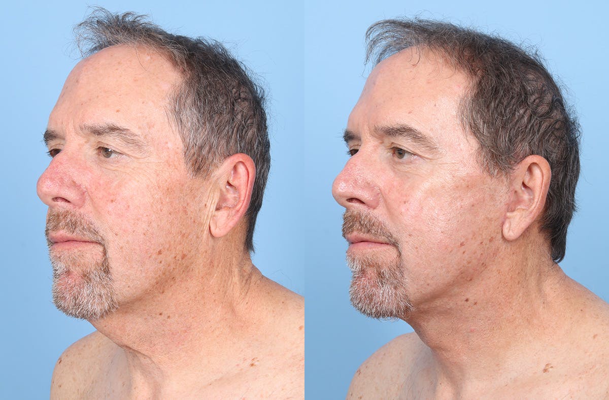 Neck Lift Before & After Gallery - Patient 274788 - Image 2