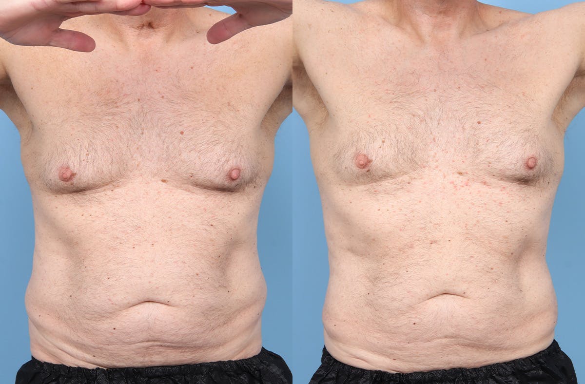 Liposuction Before & After Gallery - Patient 219448 - Image 1