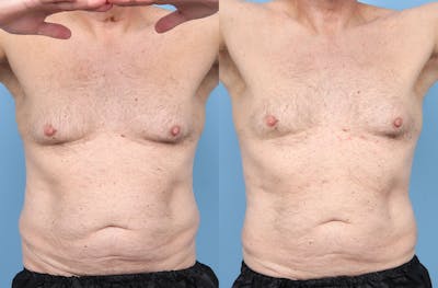 Liposuction Before & After Gallery - Patient 219448 - Image 1