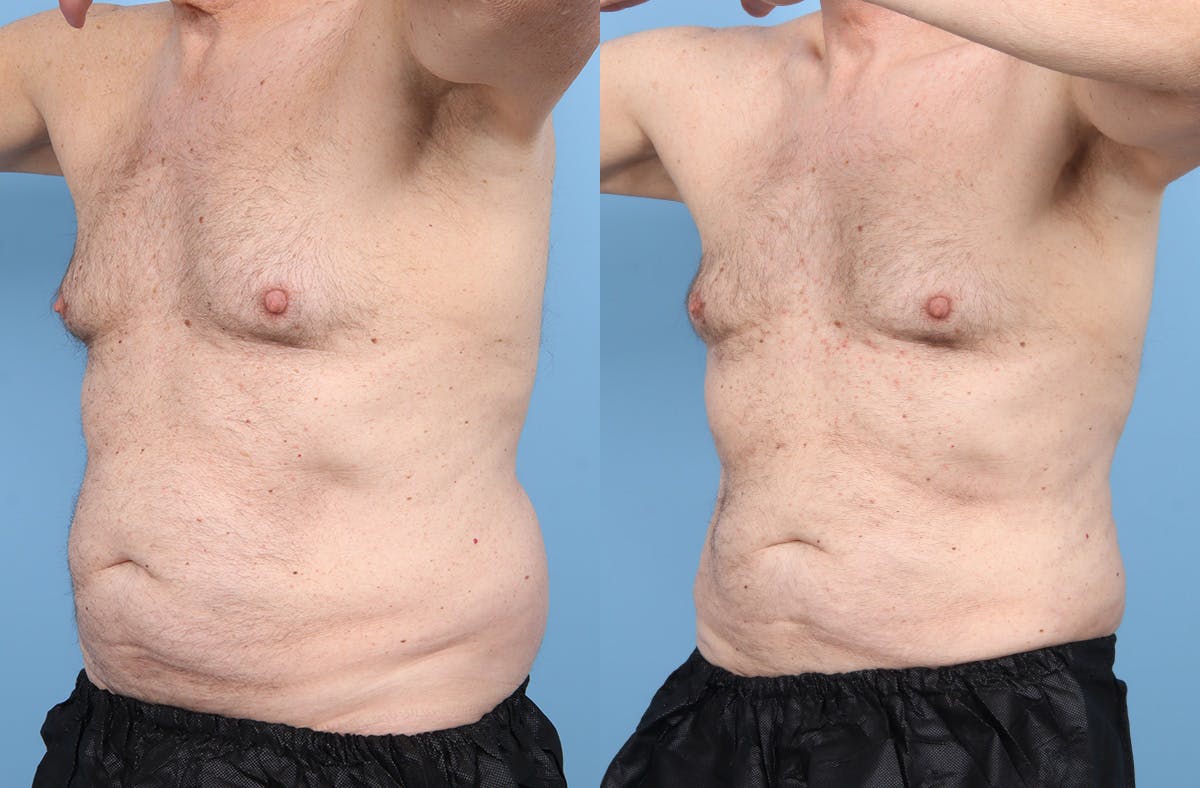 Liposuction Before & After Gallery - Patient 219448 - Image 2