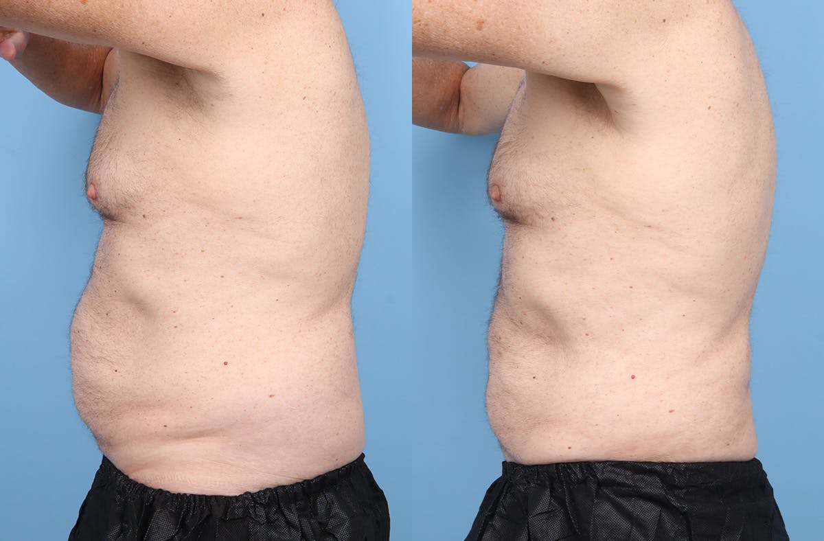 Liposuction Before & After Gallery - Patient 219448 - Image 3
