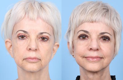 Facelift Before & After Gallery - Patient 256985 - Image 1