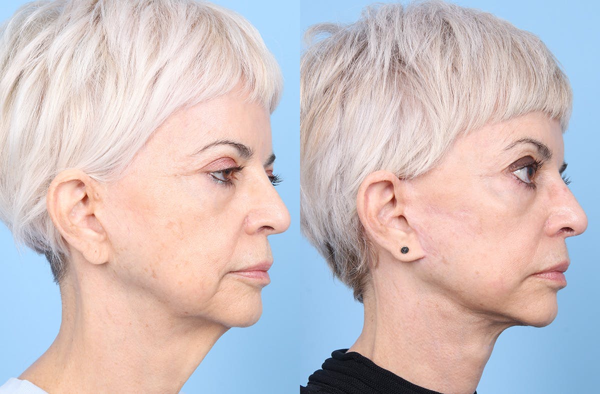 Neck Lift Before & After Gallery - Patient 120370 - Image 4
