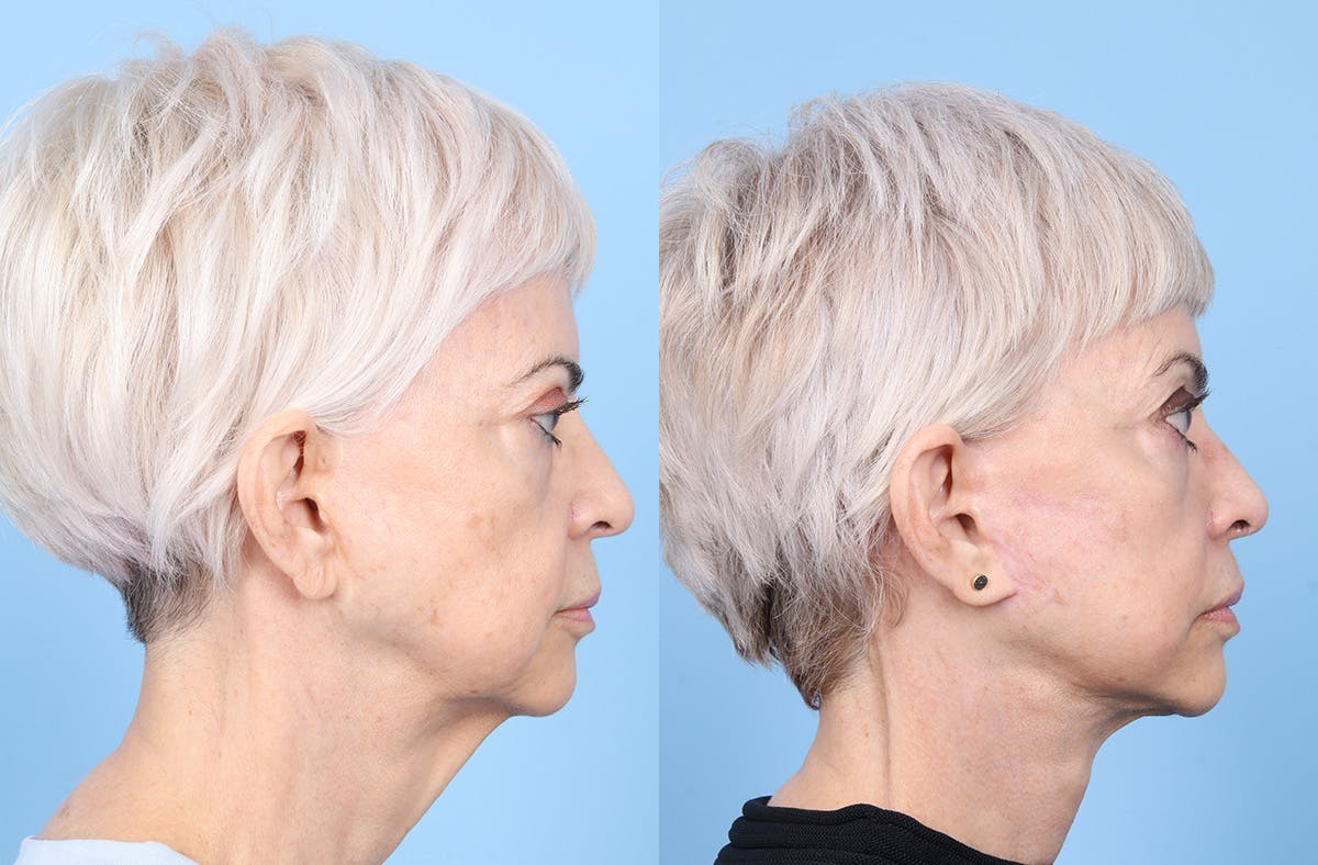 Neck Lift Before & After Gallery - Patient 120370 - Image 5