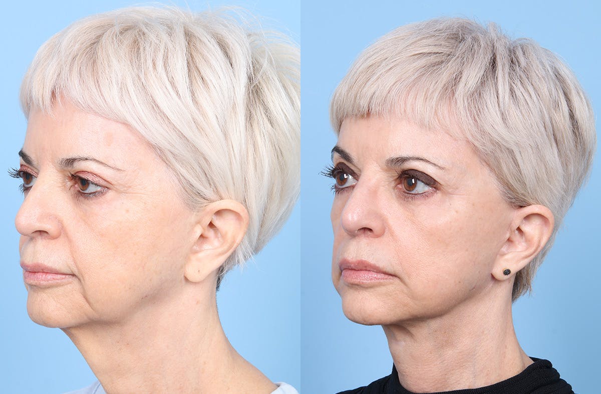 Neck Lift Before & After Gallery - Patient 120370 - Image 2