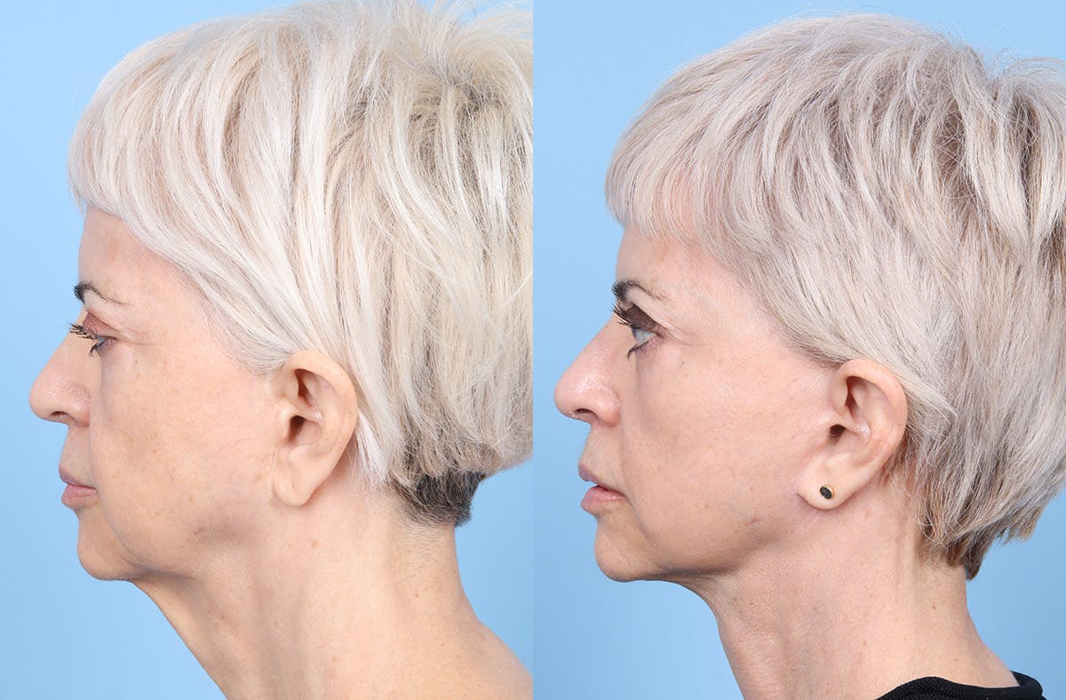 Neck Lift Before & After Gallery - Patient 120370 - Image 1