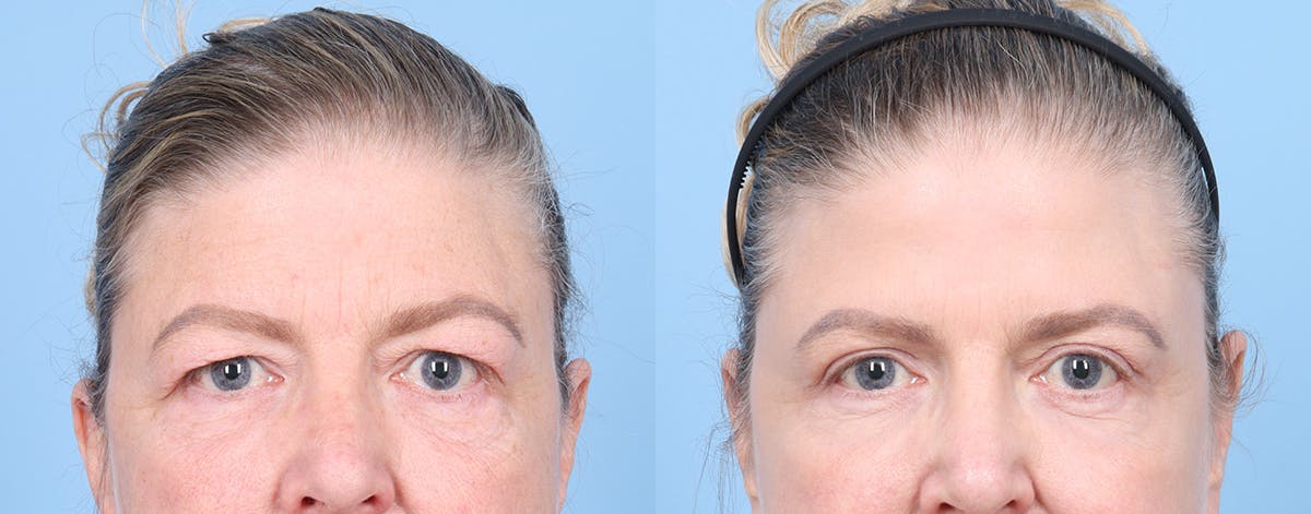 Eyelid Surgery Before & After Gallery - Patient 340727 - Image 1