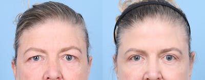 Eyelid Surgery Before & After Gallery - Patient 340727 - Image 1