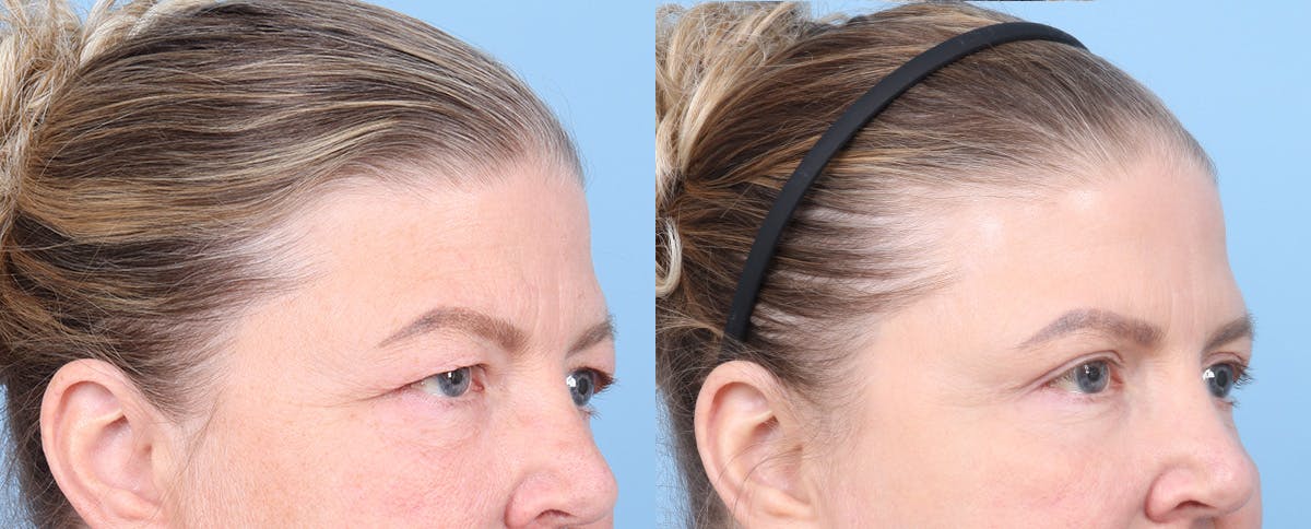 Eyelid Surgery Before & After Gallery - Patient 340727 - Image 2