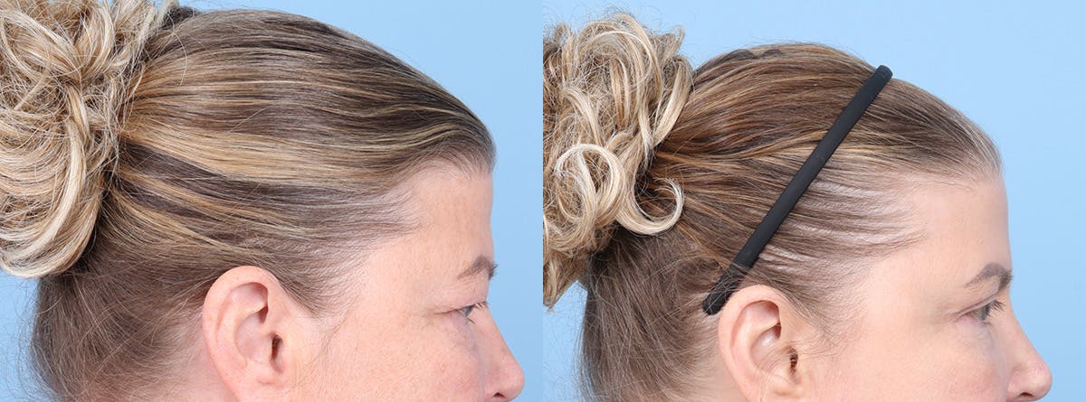 Eyelid Surgery Before & After Gallery - Patient 340727 - Image 3