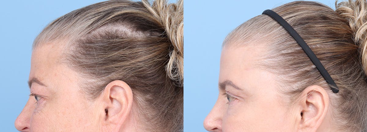 Eyelid Surgery Before & After Gallery - Patient 340727 - Image 5