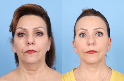 Facelift Before & After Gallery - Patient 287082 - Image 1