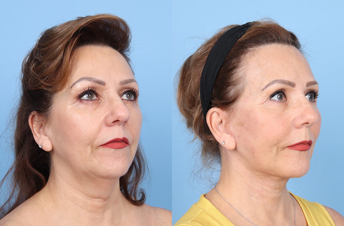 Neck Lift Before & After Gallery - Patient 578794 - Image 4