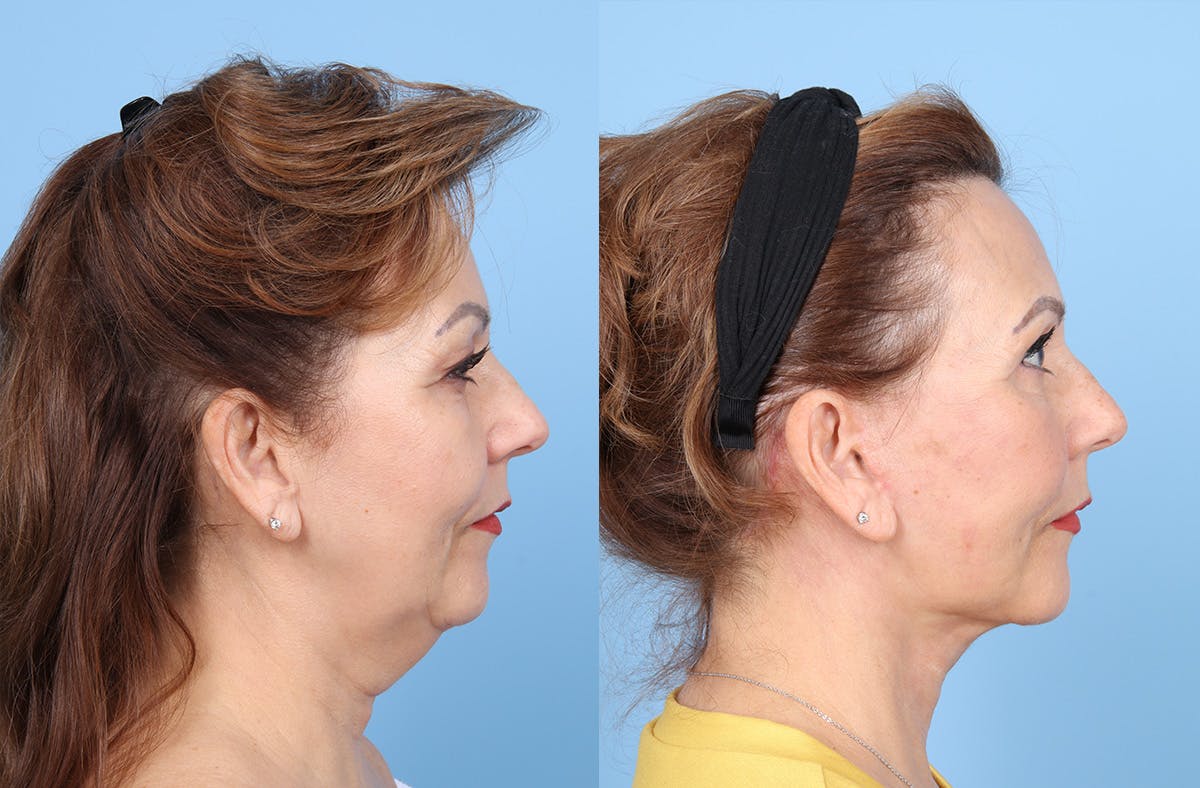Neck Lift Before & After Gallery - Patient 578794 - Image 5