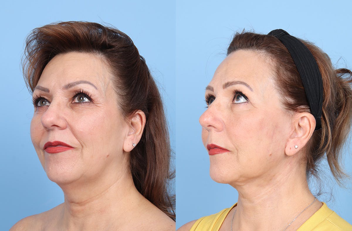 Neck Lift Before & After Gallery - Patient 578794 - Image 2