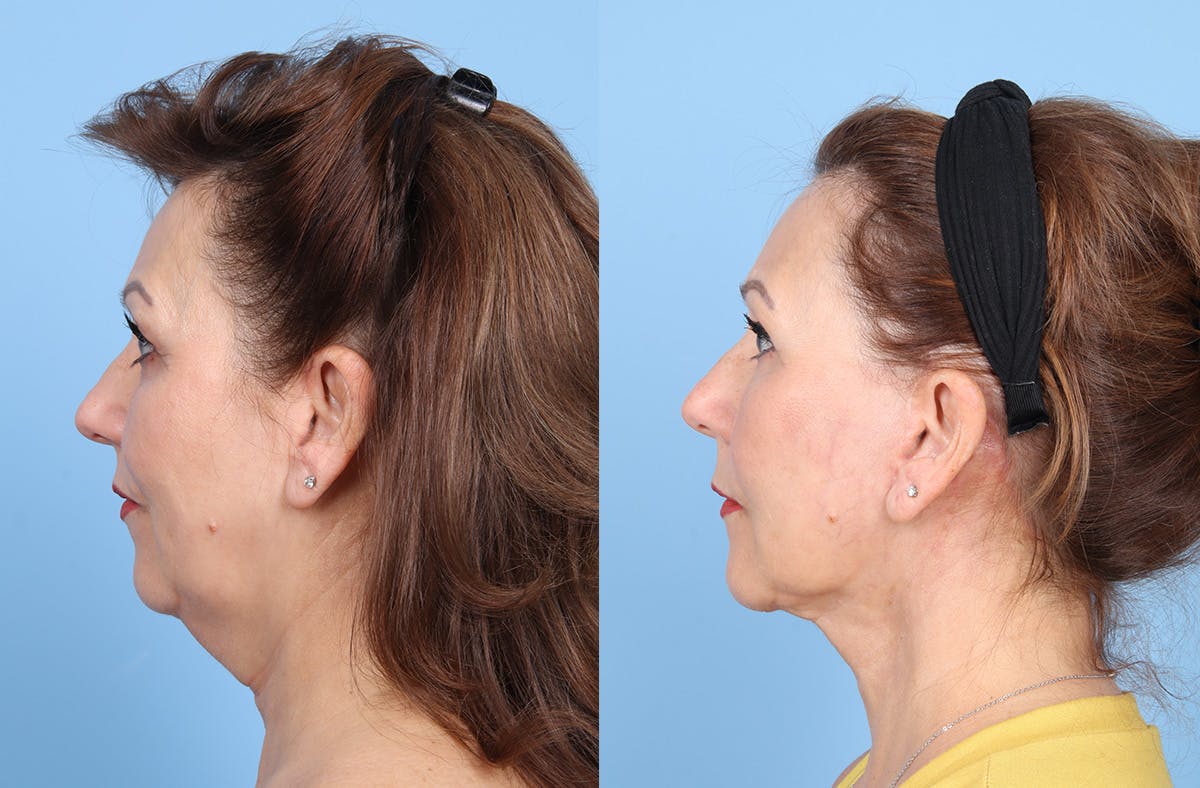 Neck Lift Before & After Gallery - Patient 578794 - Image 1
