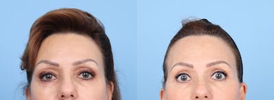 Eyelid Surgery Before & After Gallery - Patient 145850 - Image 1