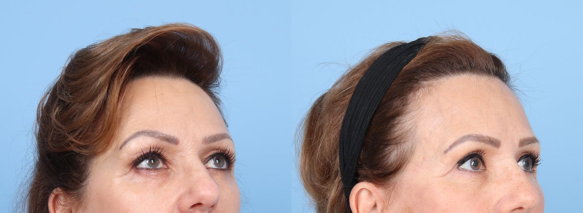 Eyelid Surgery Before & After Gallery - Patient 145850 - Image 2