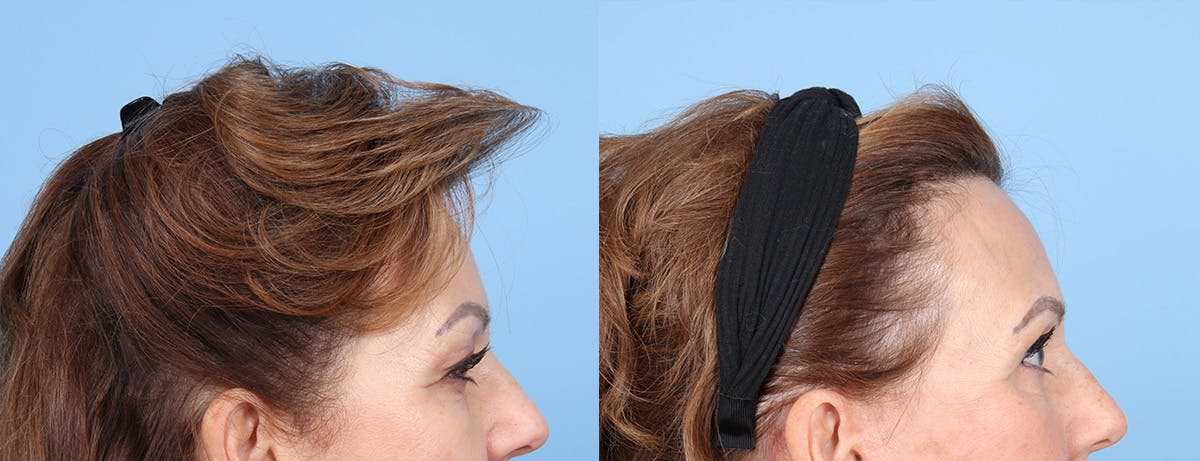 Eyelid Surgery Before & After Gallery - Patient 145850 - Image 3