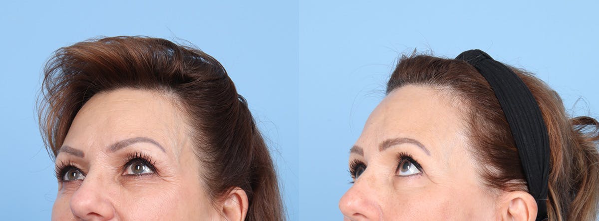 Eyelid Surgery Before & After Gallery - Patient 145850 - Image 4