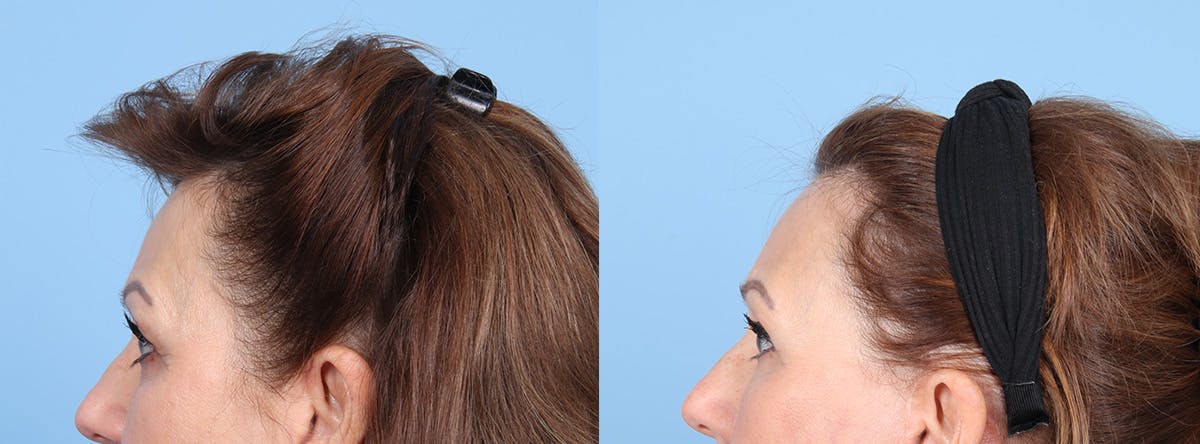 Eyelid Surgery Before & After Gallery - Patient 145850 - Image 5