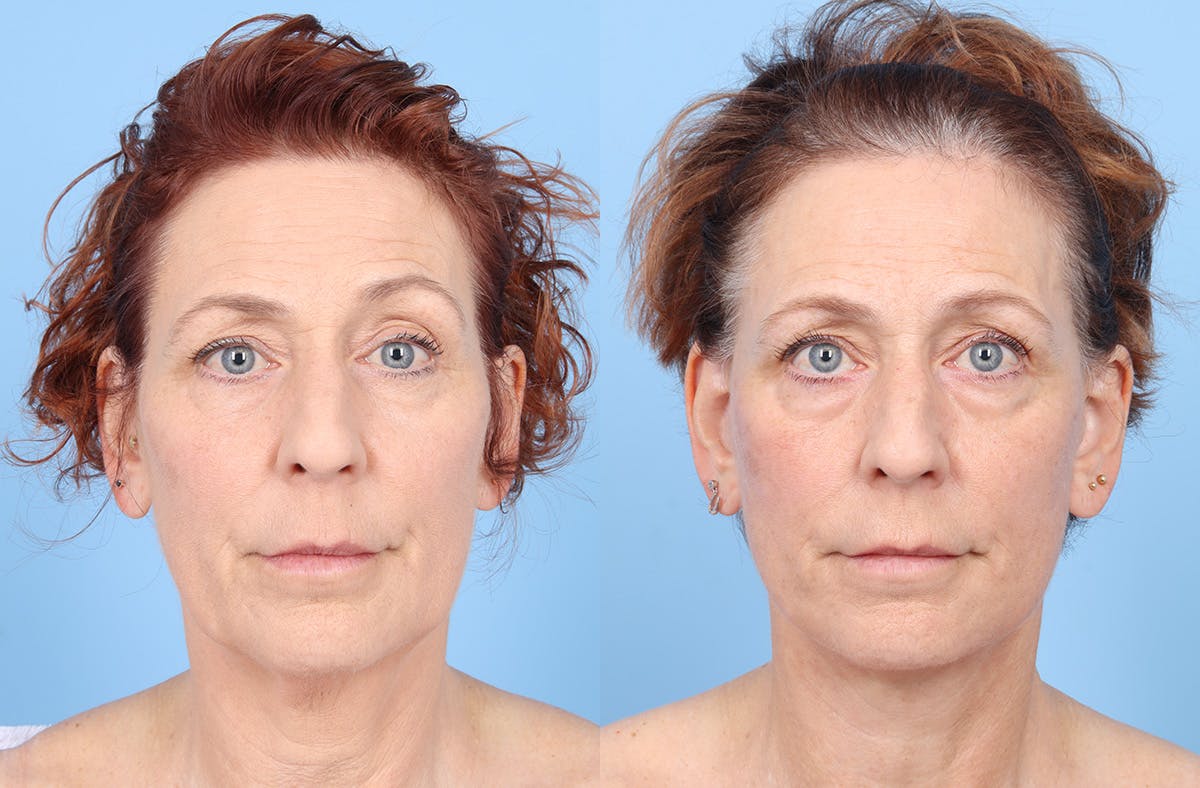 Facelift Before & After Gallery - Patient 867522 - Image 1