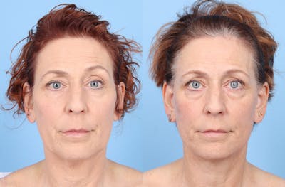 Facelift Before & After Gallery - Patient 867522 - Image 1