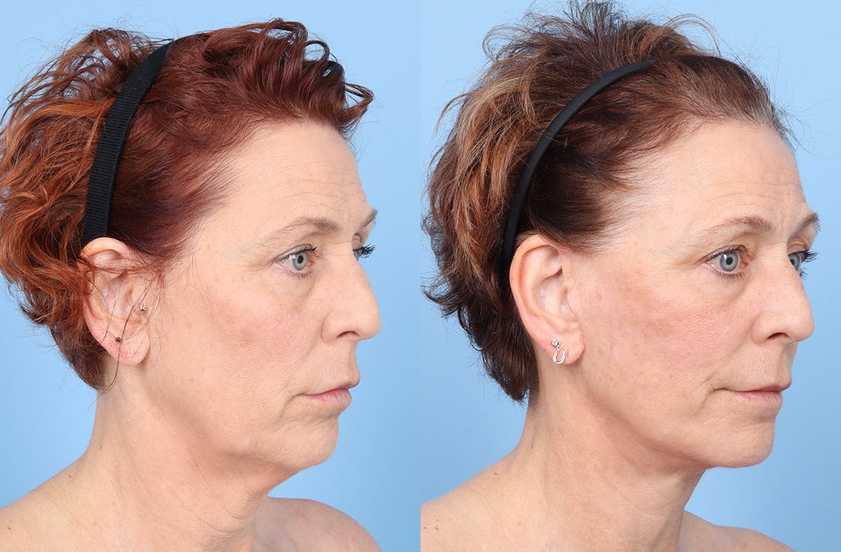 Facelift Before & After Gallery - Patient 867522 - Image 2