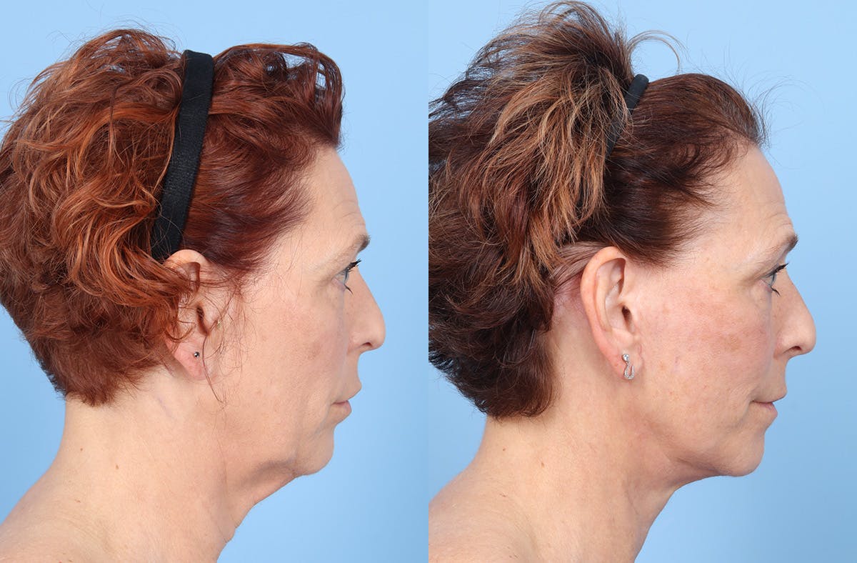 Facelift Before & After Gallery - Patient 867522 - Image 3