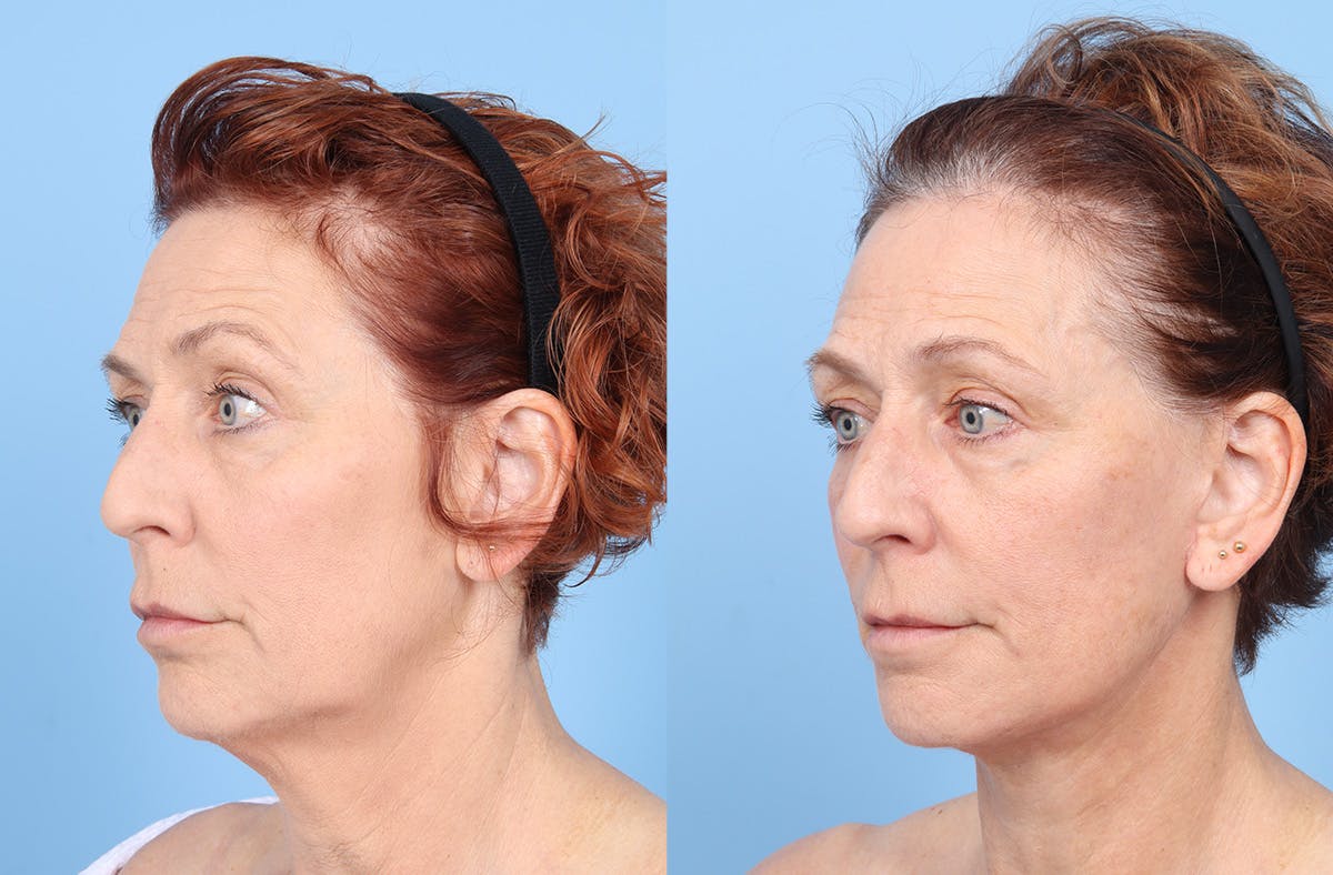 Facelift Before & After Gallery - Patient 867522 - Image 4