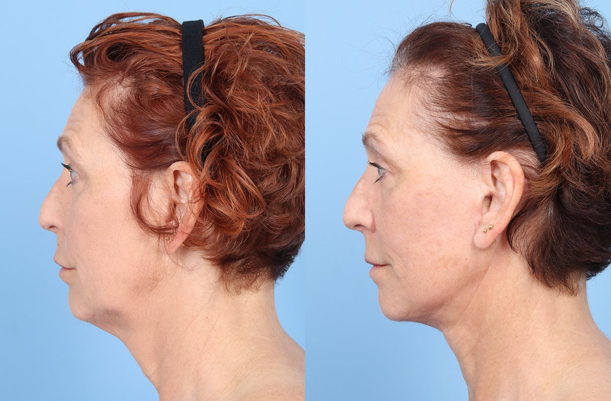 Facelift Before & After Gallery - Patient 867522 - Image 5