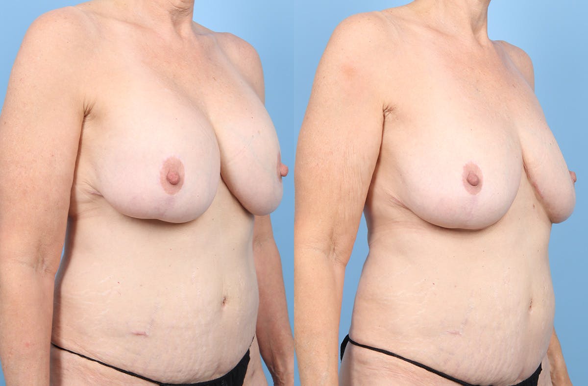Implant Removal Before & After Gallery - Patient 203922 - Image 2