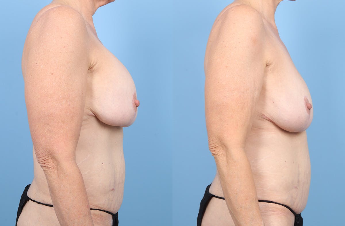 Implant Removal Before & After Gallery - Patient 203922 - Image 3