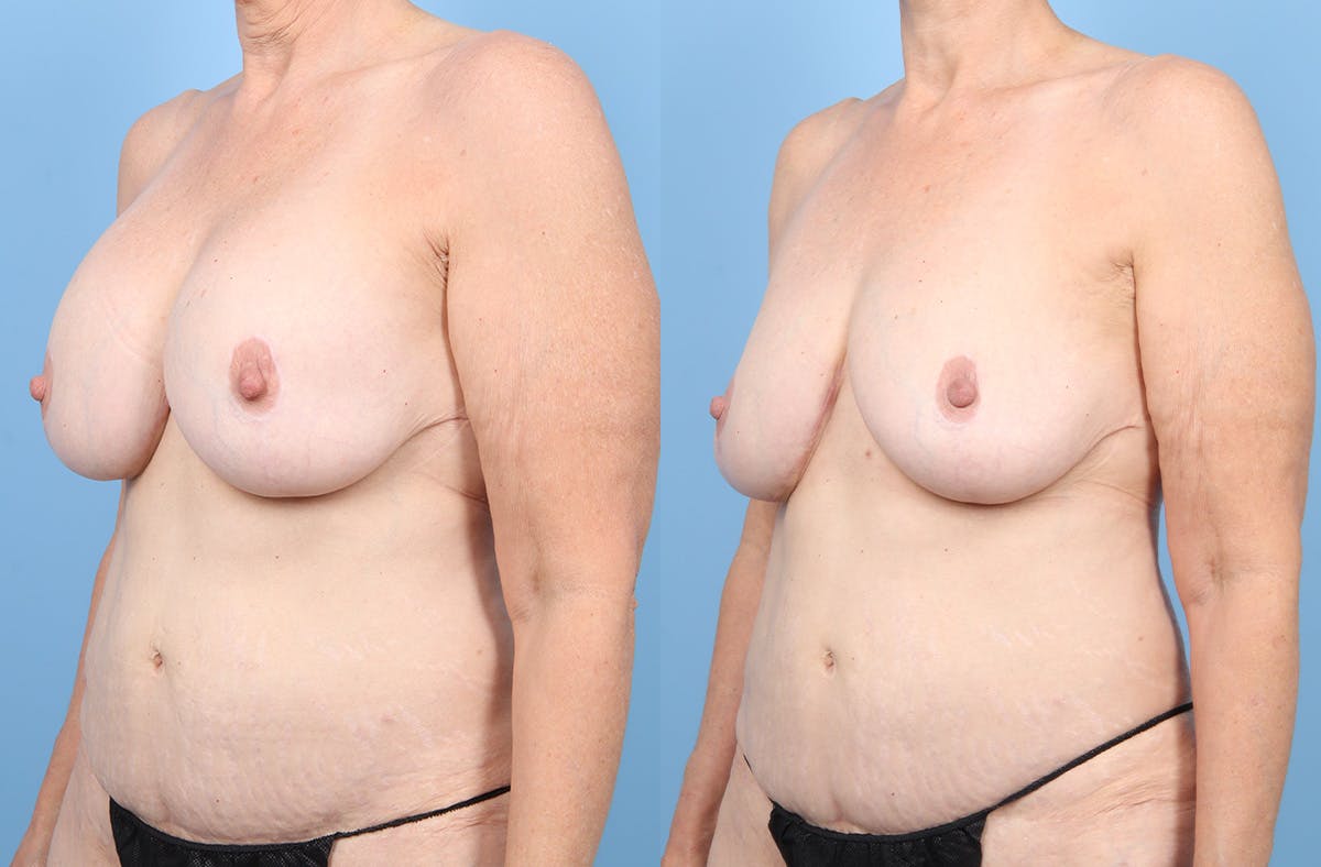 Implant Removal Before & After Gallery - Patient 203922 - Image 4