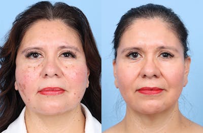 CO2 Laser Before & After Gallery - Patient 384576 - Image 1