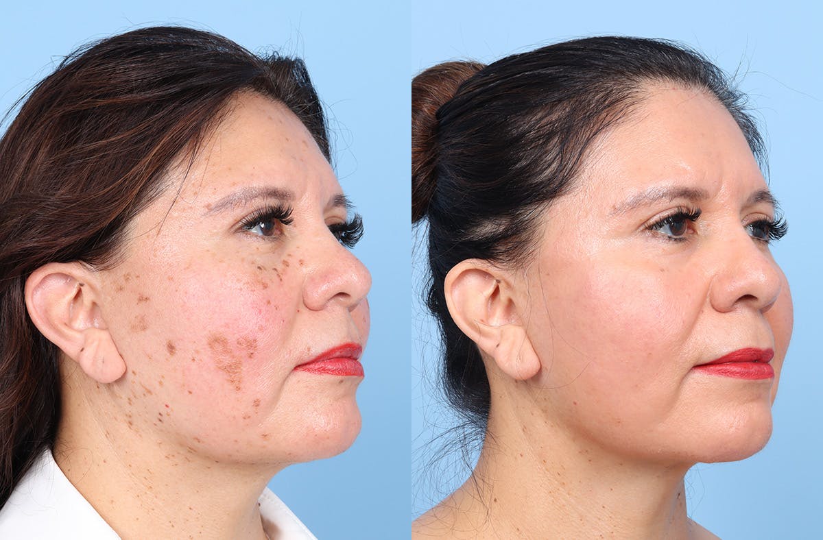CO2 Laser Before & After Gallery - Patient 384576 - Image 2