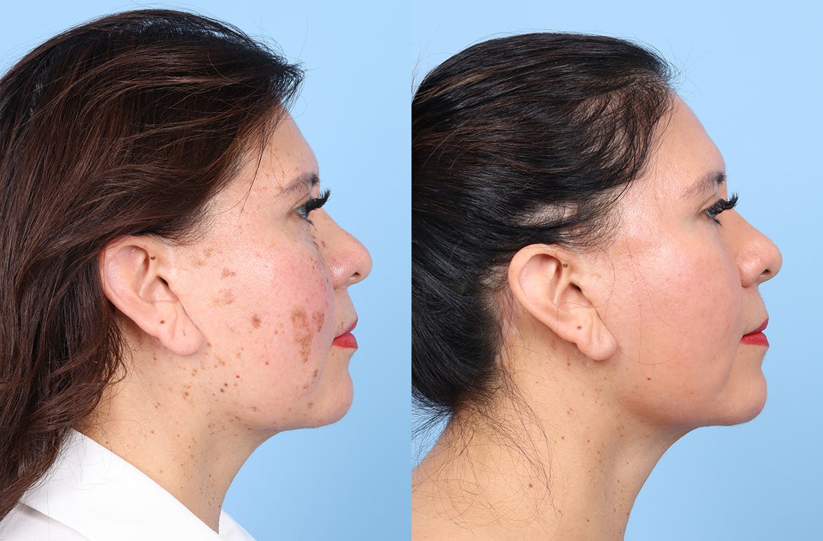 CO2 Laser Before & After Gallery - Patient 384576 - Image 3