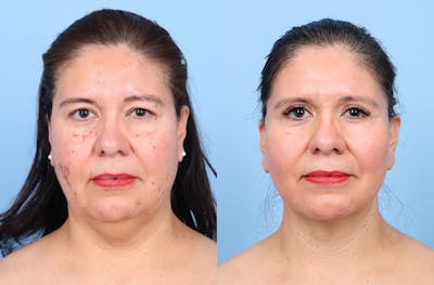 Facelift Before & After Gallery - Patient 396972 - Image 1
