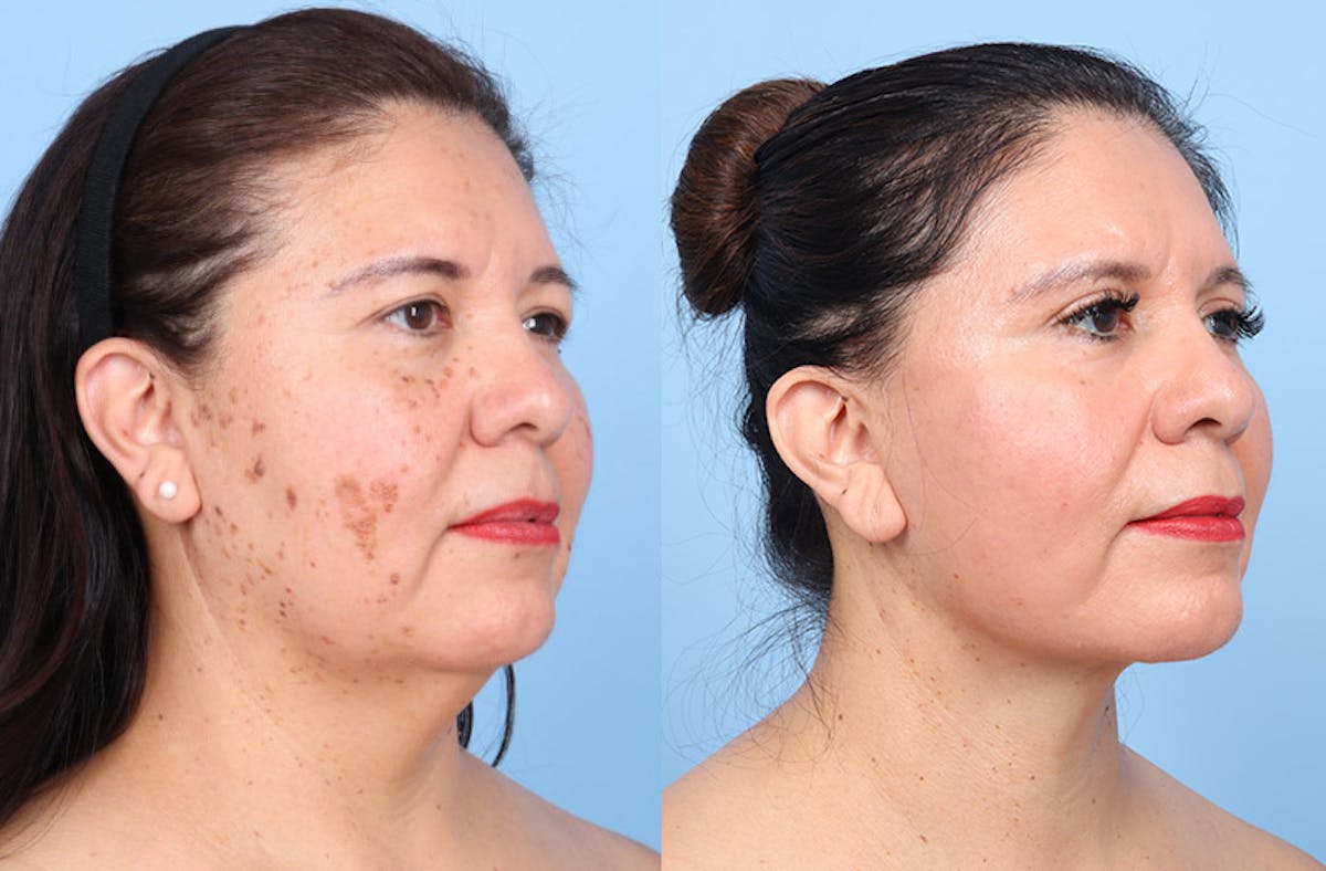 Facelift Before & After Gallery - Patient 396972 - Image 2