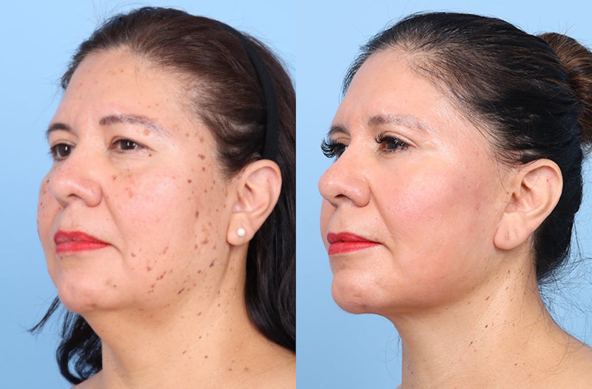 Facelift Before & After Gallery - Patient 396972 - Image 3