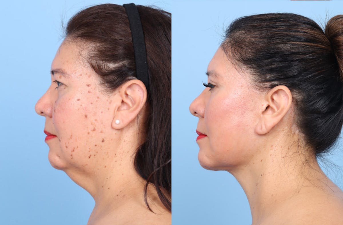 Facelift Before & After Gallery - Patient 396972 - Image 5